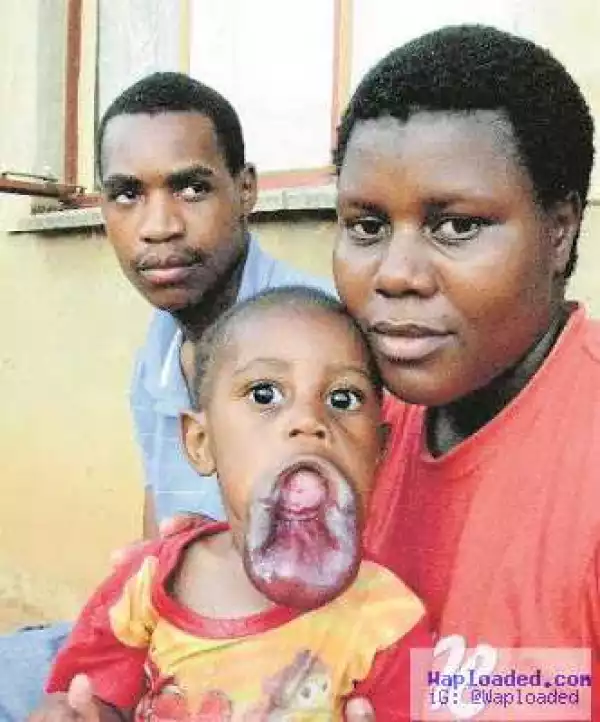 Photo: 3-year-old boy is suffering because his lower lip won